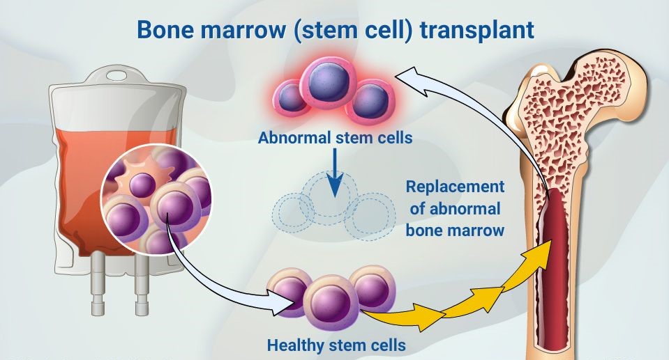Bone Marrow Transplant and BMT Specialist Care in Gurgaon