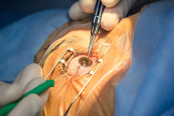 Cataract Surgery and Eye Care in Gurgaon