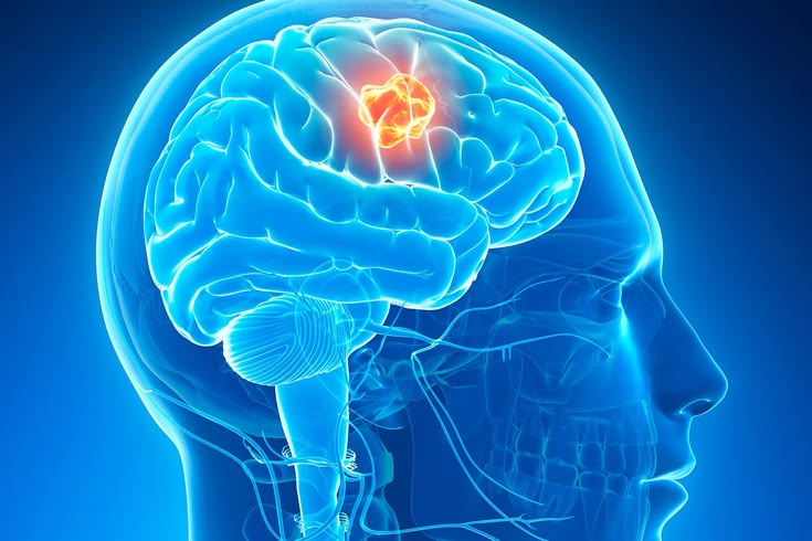 Brain Tumor Treatment in Gurgaon