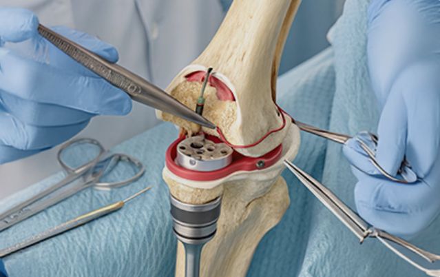Knee Replacement in Gurgaon