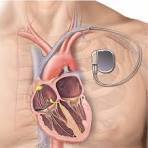 Pacemaker Implantation